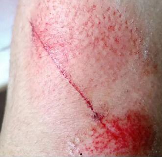 摔伤的图片,惊心动魄的瞬间回顾